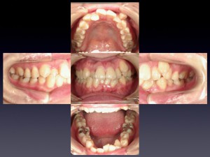 大人の前歯の凸凹は、抜歯ケースが多いです。
