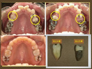歯の抜くのは、どの歯ですか？（例外もあり）