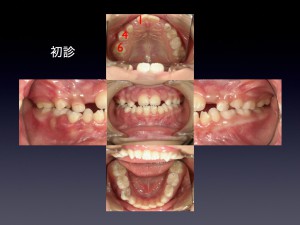 １期治療の期間は歯の生え変わりに左右されます。