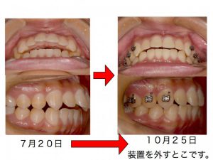 出っ歯を、早く、患者さんにわかりやすく、抜歯せずに改善できたら。